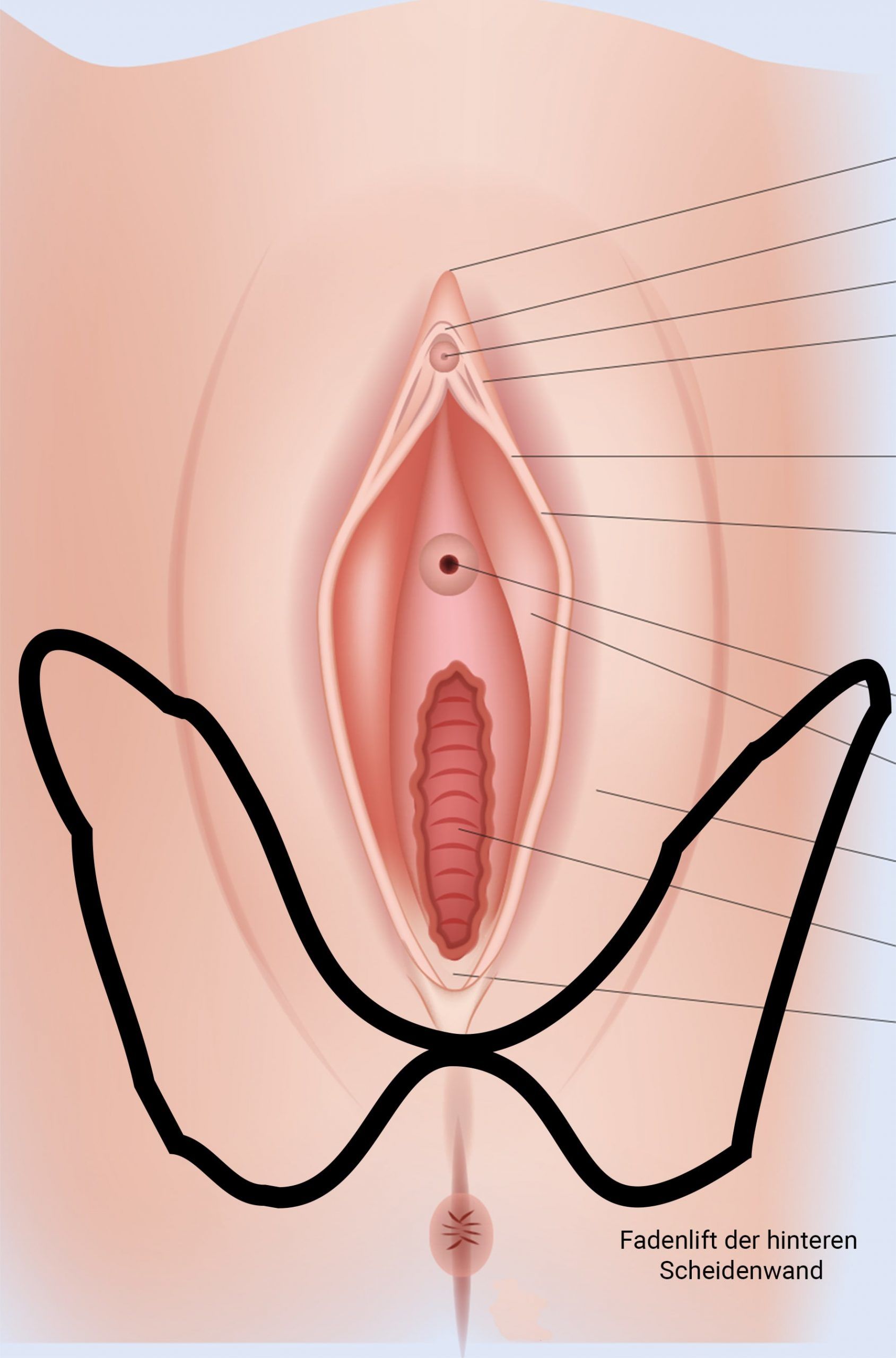 Fadenlift Scheidenwand Vaginalstraffung Mira-Beau