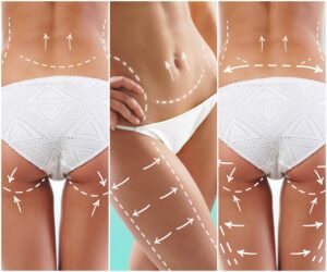 Fettabsaugung Frau Mira-Beau