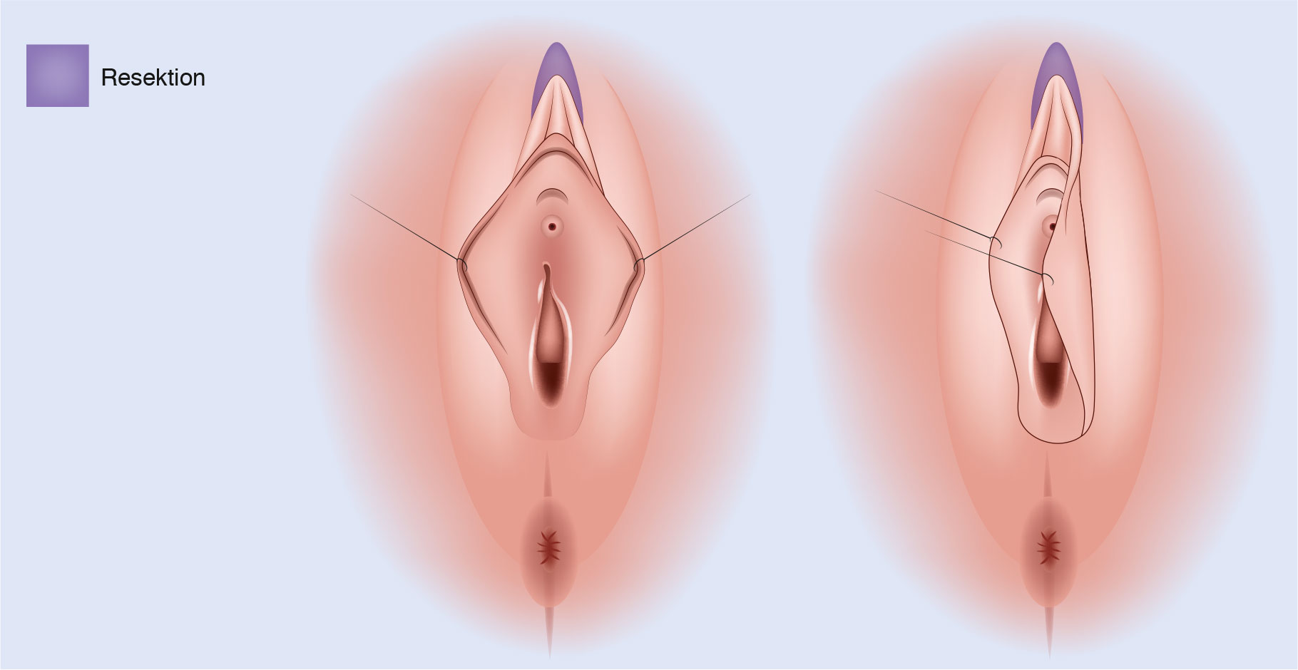 OP Technik Haubenstraffung der Schamlippen