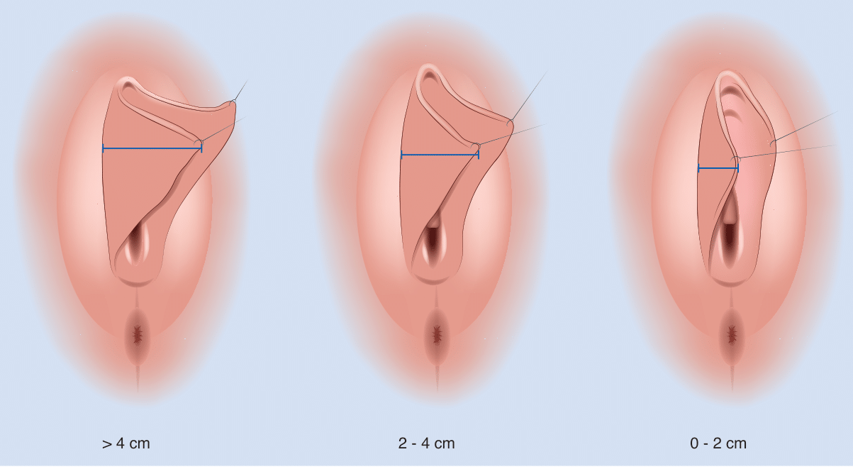 Verkleinerung kleine Schamlippen Mira-Beau